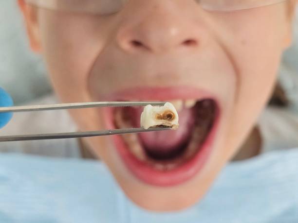 Best Walk-In Emergency Dentist in Honesdale, PA
